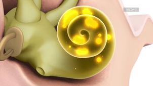 SC12 Prothèses perceptives-ANTILE SMAINA_ADJO CHANTAL AFATCHAO.mp4